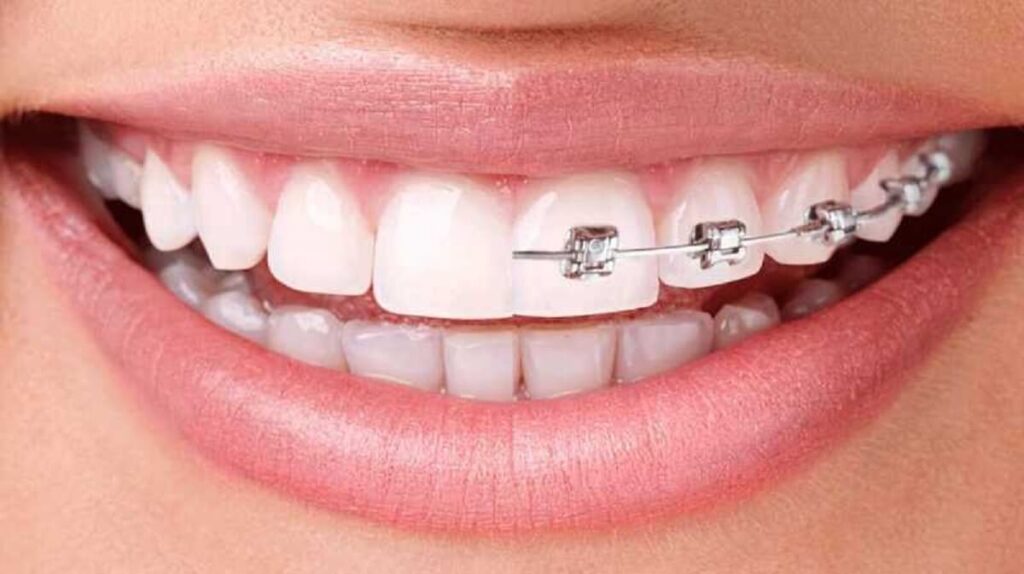 Differences Between Invisalign And Braces 4919